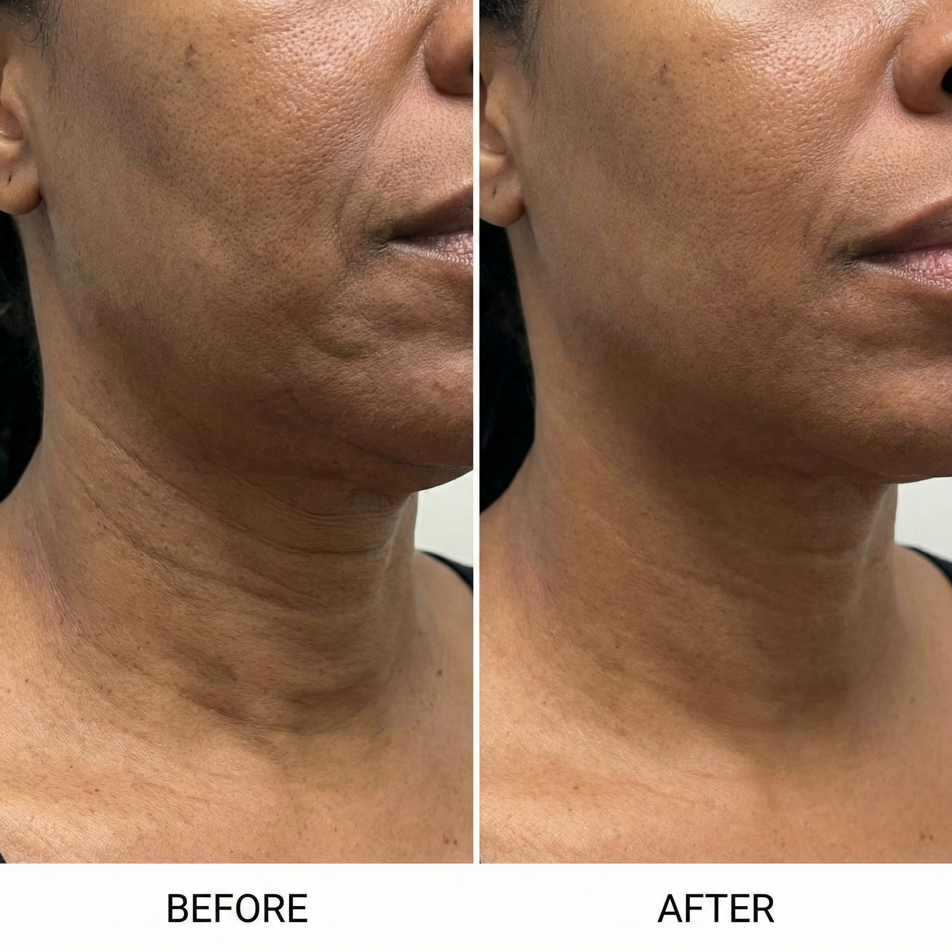 GlowVita™ Micro-Infusion Systeem