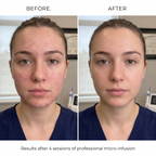 GlowVita™ Micro-Infusion Systeem