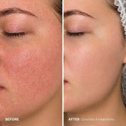 GlowVita™ Micro-Infusion Systeem