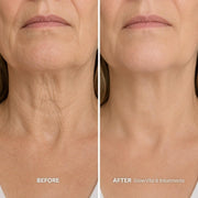 GlowVita™ Micro-Infusion Systeem